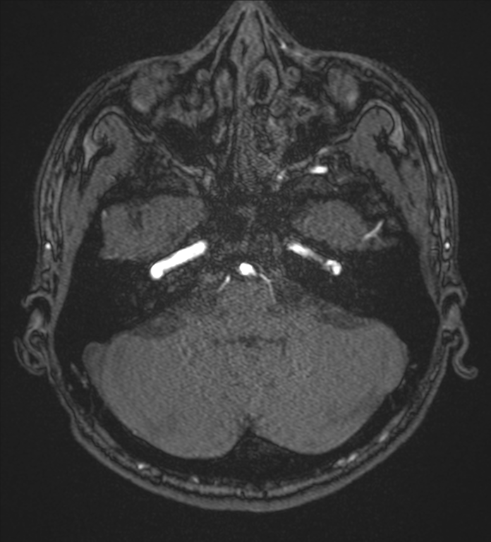Basal ganglia subacute infarct (Radiopaedia 80201-93521 Axial MRA 9).png
