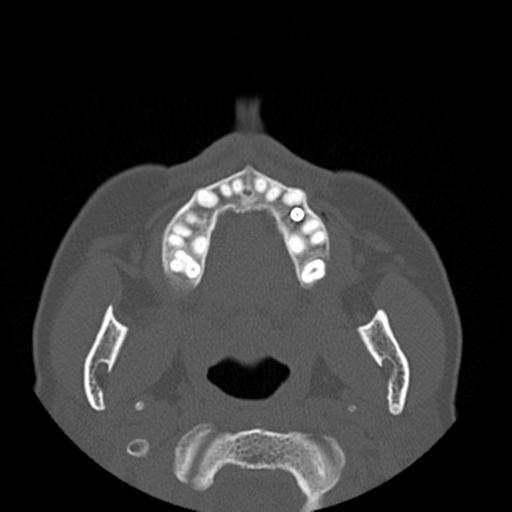 File:Base of skull chondrosarcoma (Radiopaedia 30410-31071 Axial bone window 2).jpg