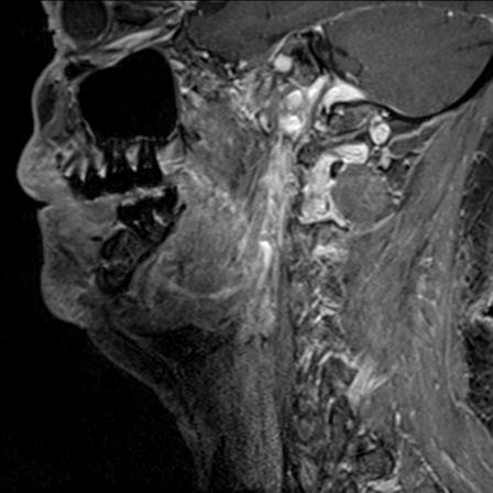 File:Base of tongue squamous cell carcinoma (Radiopaedia 31174-31884 F 120).jpg