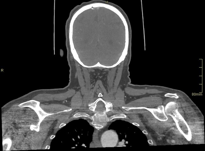 Basilar artery aneurysm (Radiopaedia 56261-62932 B 59).jpg