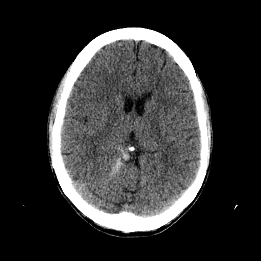 File:Basilar artery perforator aneurysm (Radiopaedia 82455-96597 Axial non-contrast 19).jpg