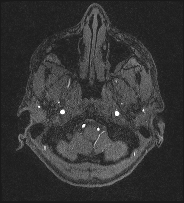 Basilar artery perforator aneurysm (Radiopaedia 82455-97733 Axial MRA 26).jpg