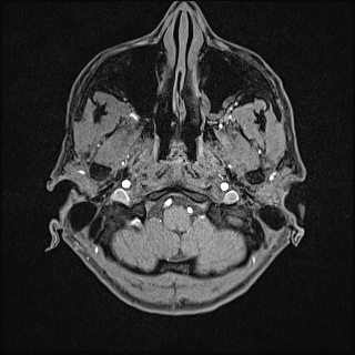 Basilar artery perforator aneurysm (Radiopaedia 82455-97733 Axial T1 fat sat 11).jpg