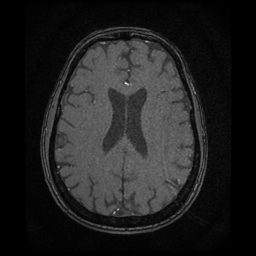 Basilar top and left middle cerebral artery aneurysm (Radiopaedia 61965-70031 Axial MRA 111).jpg