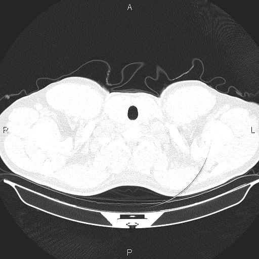 File:Beam hardening and ring artifacts (Radiopaedia 85323-100915 Axial lung window 3).jpg