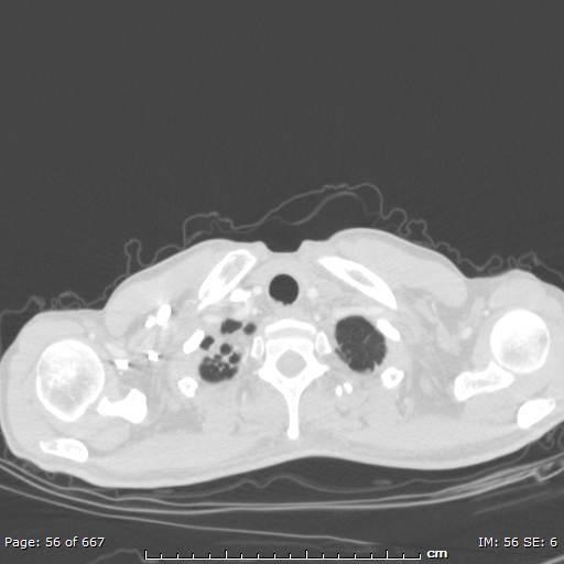 File:Behçet disease (Radiopaedia 44247-47889 Axial lung window 1).jpg