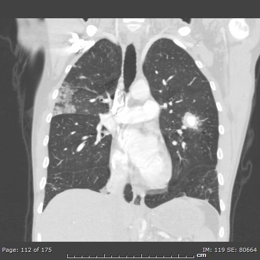 File:Behçet disease (Radiopaedia 44247-47889 Coronal lung window 34).jpg