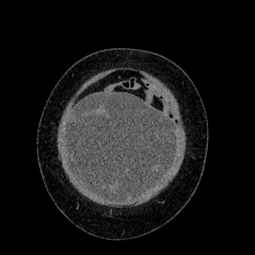 File:Benign leiomyoma with hydropic features (Radiopaedia 89250-106130 B 17).jpg