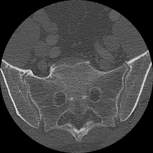 Benign post-traumatic pseudopneumoperitoneum (Radiopaedia 71199-81495 Axial bone window 294).jpg