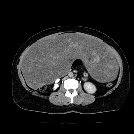 Benign spindle cell tumor - abdominopelvic (Radiopaedia 61300-69212 Axial C+ delayed 31).jpg