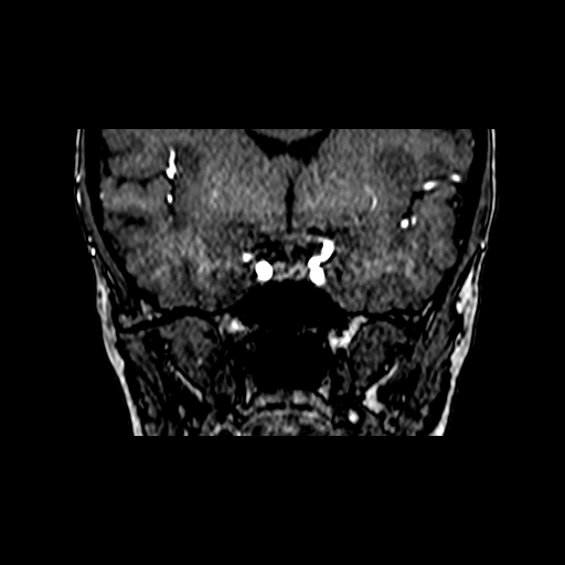 Berry aneurysm of the terminal internal carotid artery (Radiopaedia 88286-104918 Coronal TOF 39).jpg