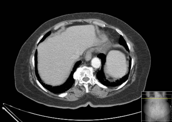 File:Bicameral celiacomesenteric aneurysm (Radiopaedia 55766-62327 A 6).jpg