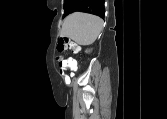 Bicameral celiacomesenteric aneurysm (Radiopaedia 55766-62327 B 14).jpg