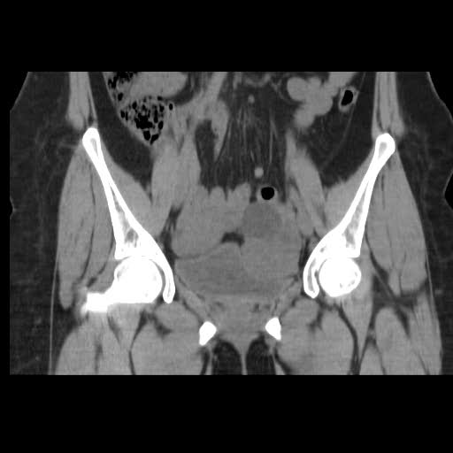 File:Bicornuate uterus- on MRI (Radiopaedia 49206-54296 Coronal non-contrast 8).jpg