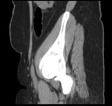 File:Bicornuate uterus (MRI) (Radiopaedia 49206-54296 Sagittal 18).png