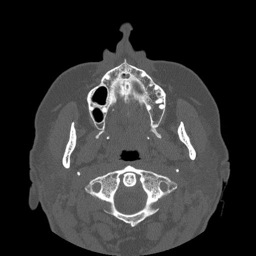 File:Bilateral Ectopic Infraorbital Nerves (Radiopaedia 49006-54084 Axial bone window 2).jpg