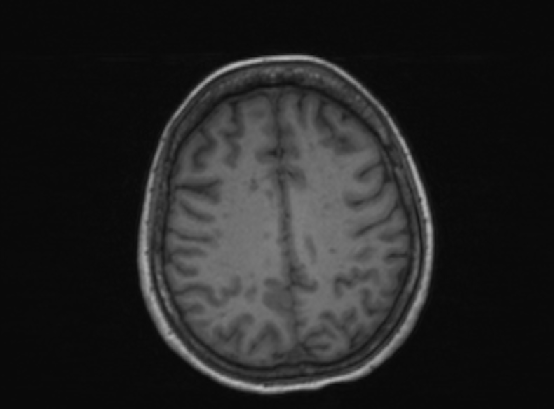 Bilateral PCA territory infarction - different ages (Radiopaedia 46200-51784 Axial T1 184).jpg