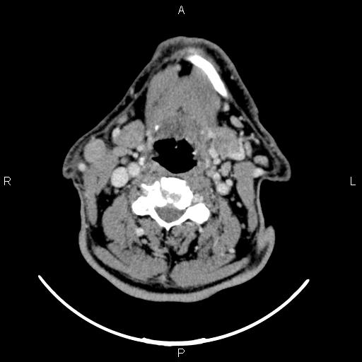 File:Bilateral Warthin tumors (Radiopaedia 84034-99263 Axial With contrast 36).jpg