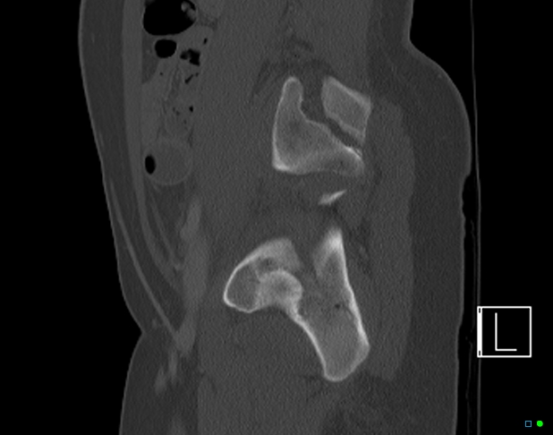 Bilateral acetabular fractures (Radiopaedia 79272-92308 Sagittal bone window 61).jpg