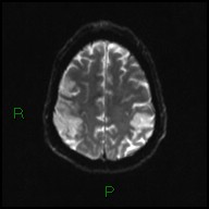 File:Bilateral acute middle cerebral artery territory infarcts (Radiopaedia 77319-89402 Axial DWI 19).jpg