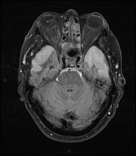 File:Bilateral acute middle cerebral artery territory infarcts (Radiopaedia 77319-89402 Axial FLAIR 8).jpg