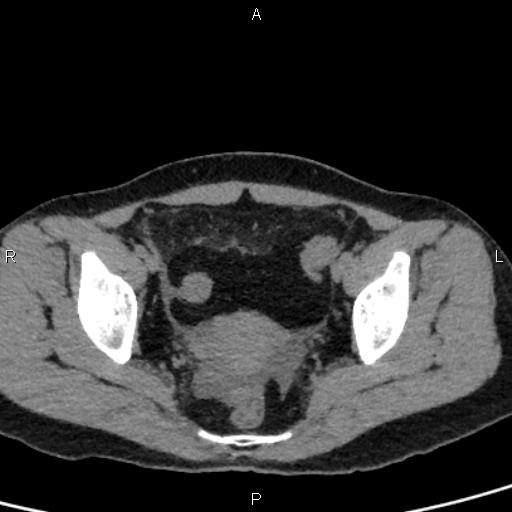 Bilateral adrenal gland hyperenhancement in pancreatitis (Radiopaedia 86642-102753 Axial non-contrast 98).jpg