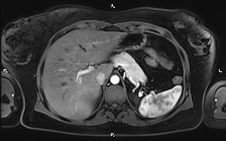 Bilateral adrenal myelolipoma (Radiopaedia 63058-71537 Axial T1 C+ fat sat 28).jpg