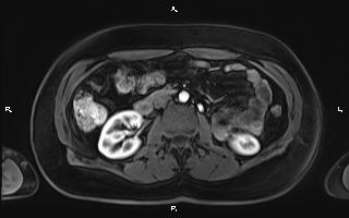 Bilateral adrenal myelolipoma (Radiopaedia 63058-71537 Axial T1 C+ fat sat 54).jpg