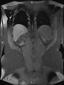 Bilateral adrenal myelolipoma (Radiopaedia 63058-71537 Coronal T1 fat sat 20).jpg