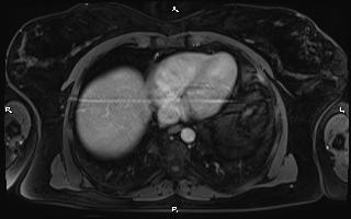 Bilateral adrenal myelolipoma (Radiopaedia 63058-71537 G 10).jpg