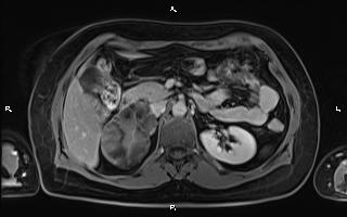 File:Bilateral adrenal myelolipoma (Radiopaedia 63058-71537 H 42).jpg