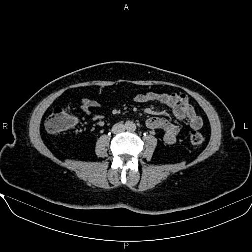Bilateral benign adrenal adenomas (Radiopaedia 86912-103124 Axial C+ delayed 89).jpg