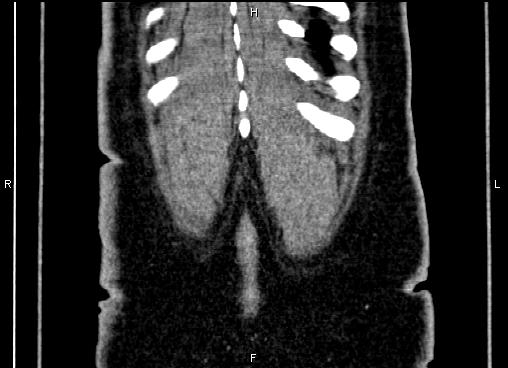 Bilateral benign adrenal adenomas (Radiopaedia 86912-103124 D 64).jpg