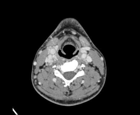 Bilateral carotid body tumors (Radiopaedia 61841-69870 Axial Post contrast 61).jpg