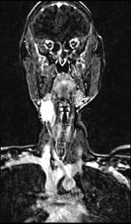 File:Bilateral carotid body tumors and right glomus jugulare tumor (Radiopaedia 20024-20060 MRA 83).jpg