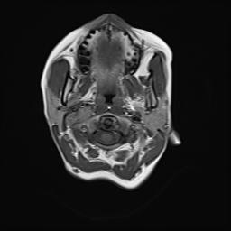 File:Bilateral carotid body tumors and right jugular paraganglioma (Radiopaedia 20024-20060 Axial 15).jpg