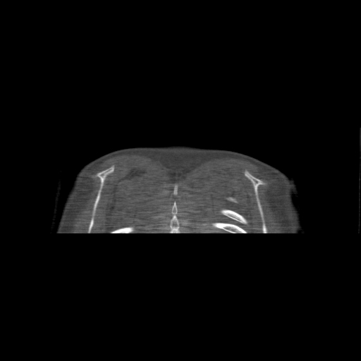 Bilateral chronic posterior shoulder dislocation (Radiopaedia 39213-41452 Coronal bone window 61).jpg