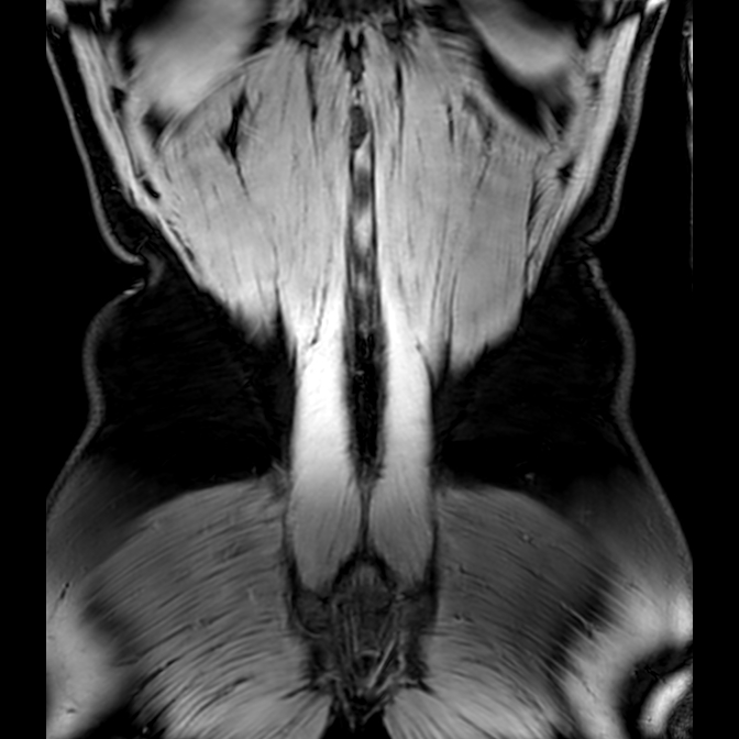 Bilateral conjoined nerve roots at different levels (Radiopaedia 73312-84063 Coronal WE 56).jpg