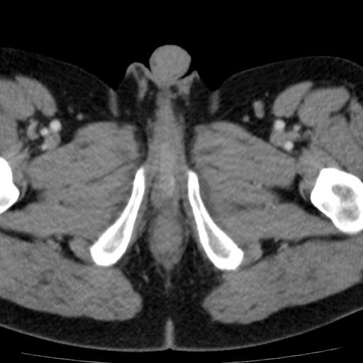 File:Bilateral direct inguinal herniae (Radiopaedia 17016-16719 B 31).jpg