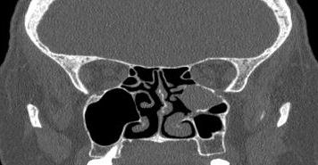 File:Bilateral ectopic infraorbital nerves (Radiopaedia 49006-54084 Coronal 21).png