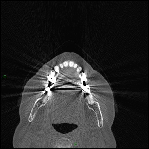 File:Bilateral frontal mucoceles (Radiopaedia 82352-96454 Axial bone window 276).jpg
