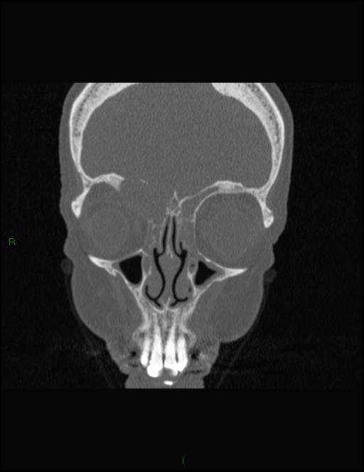Bilateral frontal mucoceles (Radiopaedia 82352-96454 Coronal 104).jpg