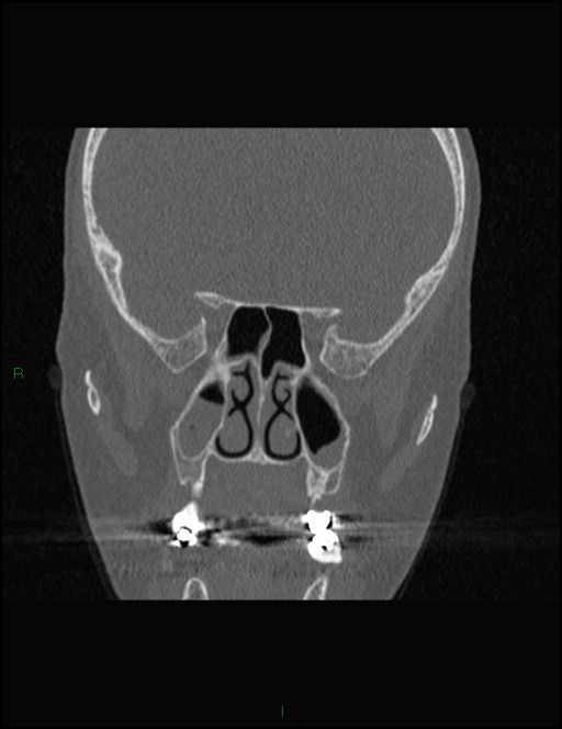 Bilateral frontal mucoceles (Radiopaedia 82352-96454 Coronal 184).jpg
