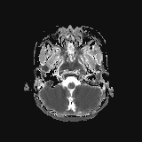 File:Bilateral mesial temporal polymicrogyria (Radiopaedia 76456-88181 Axial ADC 3).jpg