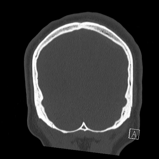 Bilateral occipital condyle fracture (type 2) (Radiopaedia 87675-104089 Coronal bone window 128).jpg