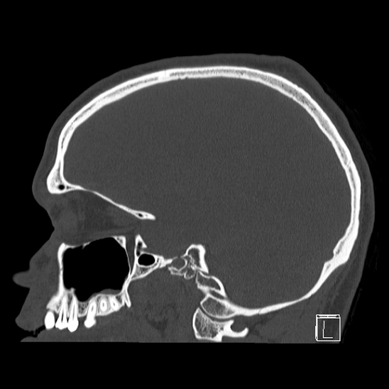 Bilateral occipital condyle fracture (type 2) (Radiopaedia 87675-104089 Sagittal bone window 73).jpg