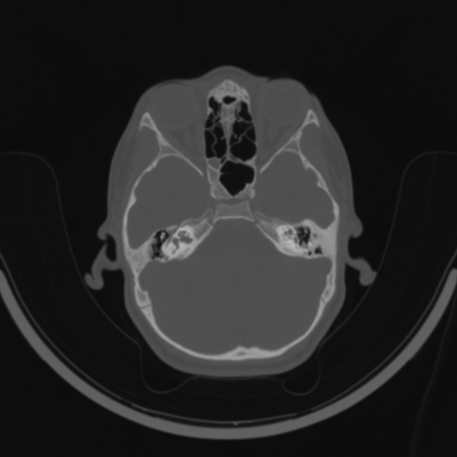 Bilateral otosclerosis (Radiopaedia 57237-64157 C 46).jpg