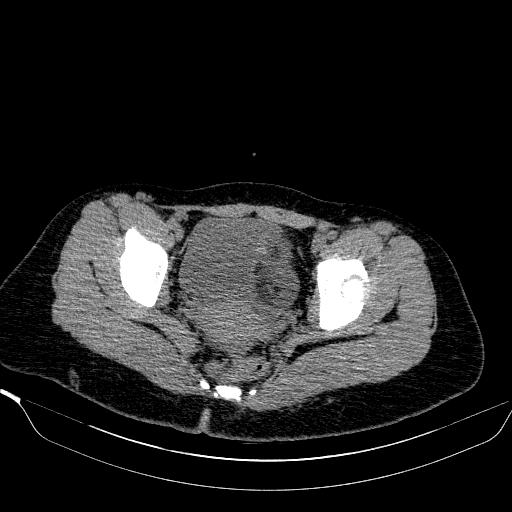 File:Bilateral ovarian dermoid (Radiopaedia 45714-49907 Axial non-contrast 33).JPEG