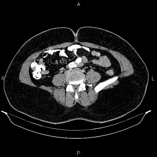 Bilateral ovarian dermoid cysts (Radiopaedia 85785-101603 A 69).jpg