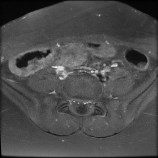File:Bilateral ovarian fibrothecomas - adolescent (Radiopaedia 86604-102707 Axial T1 C+ fat sat 4).jpg